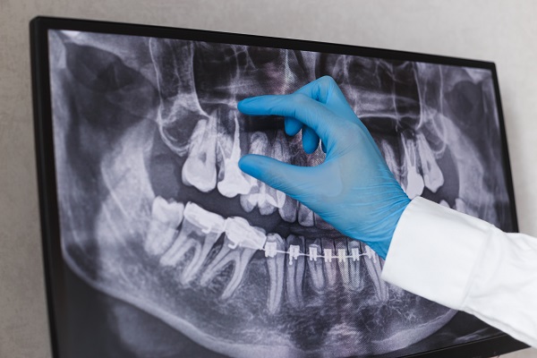 Signs You May Need A Root Canal