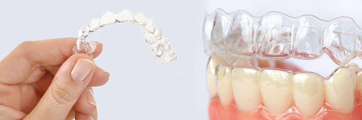 San Clemente Alternative to Braces for Teens