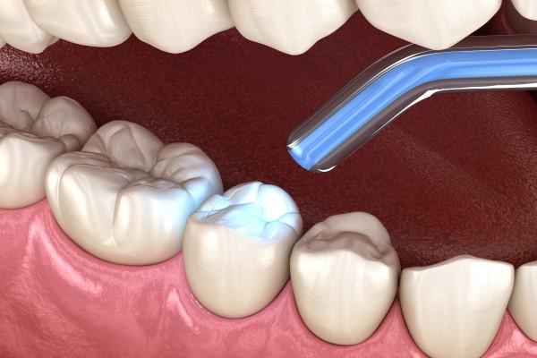 Why You Should Get Cavities Treated With Dental Fillings