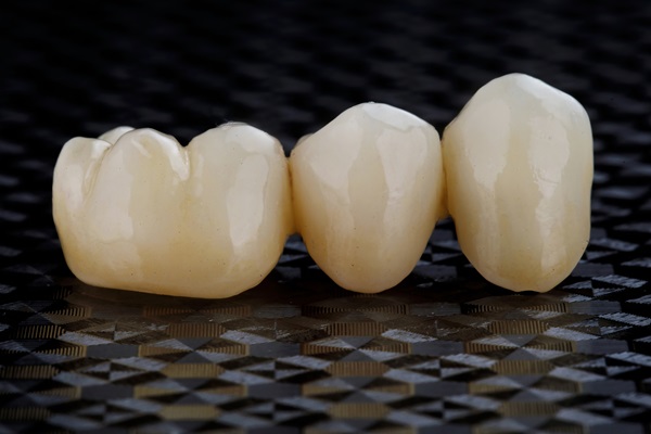 Tooth Replacement : Why A Dentist May Recommend A Dental Bridge