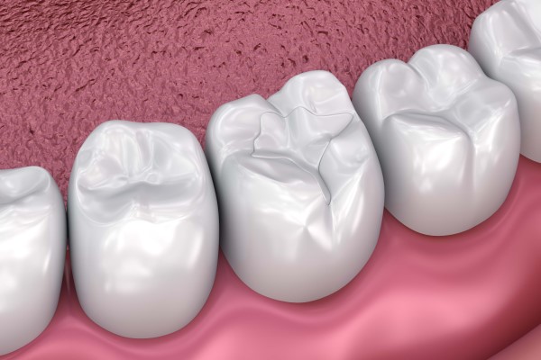 When Should You Replace An Old Dental Filling?