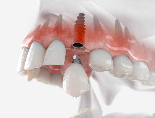 What Happens After Dental Implants Are Placed?