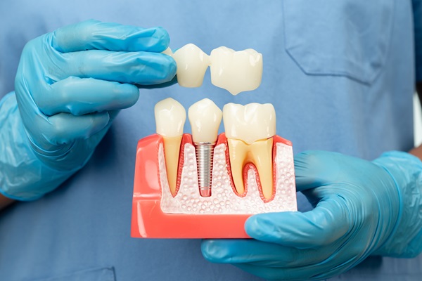 How Dental Implants Improve Oral Health And Function