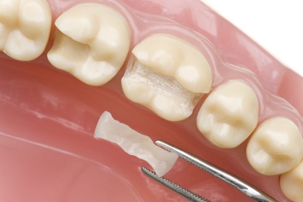 How Does Dental Sealant Treatment Work?