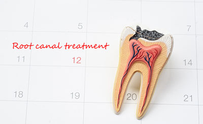 Learn About Root Canal Therapy In San Clemente