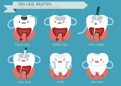 Laser Dentistry In Our San Clemente Dentist Office Can Make A Laser Root Canal Far More Comfortable
