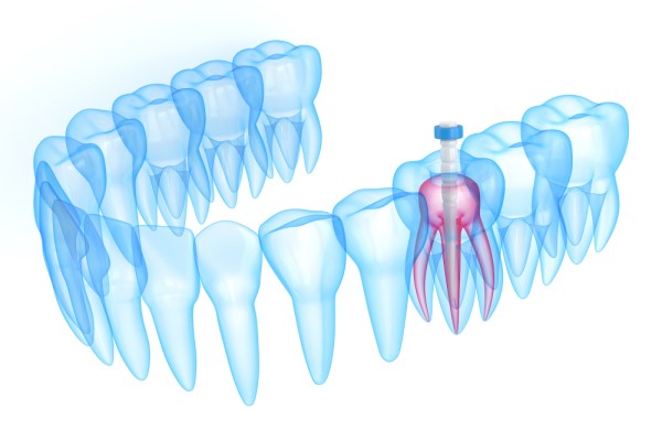 Tips To Prepare For Root Canal Treatment