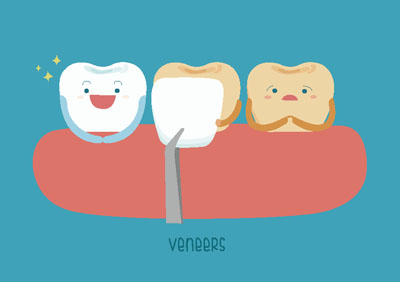 How Long Do Veneers Last On Front Teeth?